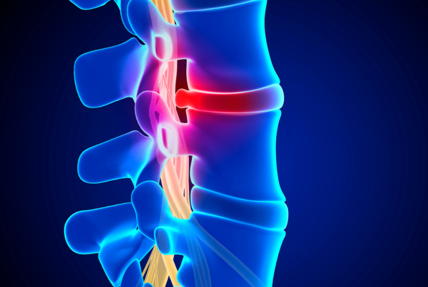Spinal Cord Stimulator